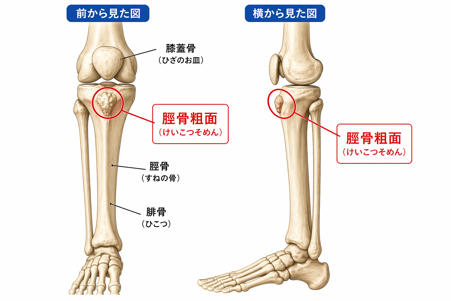 脛骨粗面の位置を示した脚の骨格図（前面と側面から見た膝下の出っ張り部分を強調）